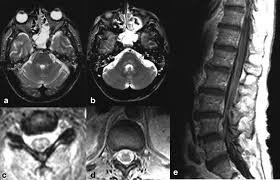 The characteristic feature of hse is hemorrhagic necrosis of the temporal lobe. Imaging Of Central Nervous System Viral Diseases Gupta 2012 Journal Of Magnetic Resonance Imaging Wiley Online Library