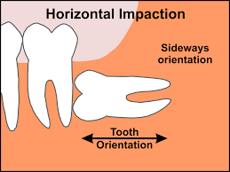 How much you can expect to pay out of pocket for wisdom teeth removal, including what people paid. Removing Wisdom Teeth