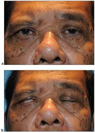 Symptoms can vary from mild to severe. Facial Paralysis And Bell S Palsy Rocky Mountain Eye Center