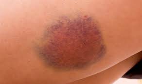 Prellungen, hämatome, blutergüsse und blaue flecken am hintern sind normalerweise keine ernste angelegenheit. Schnelle Hilfe Bei Bluterguss Gutekueche At