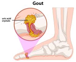 Image result for gout symptoms toe