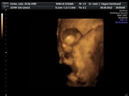 Ultraschall 20.ssw (19+3) junge, outing, its a boy, sonographie, pregnant, baby, schwanger. Total Entauscht Von 3d 4d Ultraschall Schwanger Wer Noch
