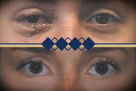 Image result for Eyelid Closure Defect