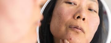 Laser treatment for acne scars