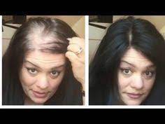 Follow these styling tips from webmd for women with thinning hair. Uniwigs 5x5 Human Hair Topper Conceal Thinning Hair In A Snap Youtube What Causes Hair Loss Help Hair Loss Thin Hair Solutions