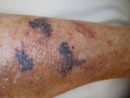 It is most commonly seen on the dorsal aspect of the forearms and is due to the accumulation of uv damage in the skin which ultimately leads to atrophy. Senile Purpura Dermnet Nz