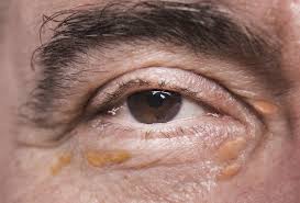 Image result for xantelasma