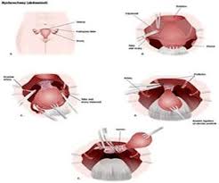 Does insurance cover laparoscopy in india. Advanced Laparoscopic Hystrectomy Surgery Best Hospitals Surgeons And Cost In India