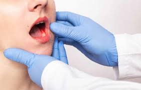 .hindi, 2• mouth cancer causes in hindi, 3• oral cancer symptoms in hindi, 4• oral cancer causes in hindi, 5• muh ka cancer kaise hota hai, 6• muh.13• mouth cancer symptoms of mouth cancer includes • a sore, irritation, lump or thick patch in your mouth, lip, or throat a white or red patch. à¤® à¤¹ à¤• à¤• à¤¸à¤° à¤• à¤²à¤• à¤·à¤£ à¤• à¤°à¤£ à¤‡à¤² à¤œ à¤¦à¤µ à¤ªà¤¹à¤š à¤¨ à¤‰à¤ªà¤š à¤° à¤¡ à¤• à¤Ÿà¤° Mouth Cancer Symptoms Causes Treatment Doctor Medicine Prevention In Hindi