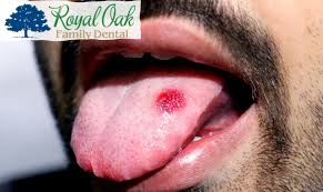Image result for cancer of tongue