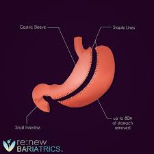 Check spelling or type a new query. Gastric Sleeve Pouch Reset Restart The Weight Loss