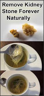 Without Surgery How To Pass A Kidney Stone Forever In 24 Hours It Scared Us When We Heard About K Kidney Stones Kidney Stone Diet Recipes Kidney Stones Remedy