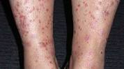 Early Stage Psoriasis On Legs