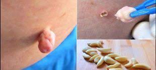 Bu Dogal Yontem Birkac Gun Icinde Sigilleri Benleri Ve Cilt Lekelerini Dokuyor Skin Tags Home Remedies Skin Tag Removal Remove Skin Tags Naturally