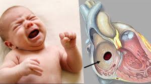 Newborn Baby Heart Hole Reason, Symptoms & Treatment: बच्चे के दिल में छेद  का कारण, लक्षण और इलाज