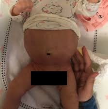20 Days Old Baby With A Big Belly Image February 2019 Babies Forums What To Expect