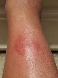 Image result for wolf spider bite skin