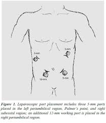 In almost three fourths of cases, the indications for using palmer's point were previous laparotomy or the presence of large uterine fibroids. Laparoscopic Ladda A A S Procedure For Intestinal Malrotation In The Adult Patient Without Volvulus Surgical Technique