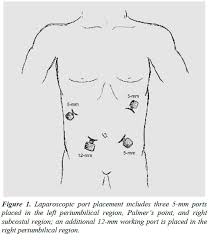 Palmer's point access for laparoscopic prostatectomy—tüfek et al urology journal vol 7 no 3 summer 2010 153 have been advocated. Laparoscopic Ladda A A S Procedure For Intestinal Malrotation In The Adult Patient Without Volvulus Surgical Technique