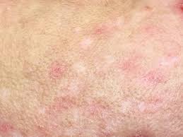 Image result for Postinflammatory Hypopigmentation