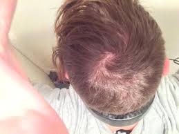 In men, hair loss usually begins above the temples, and the receding hairline eventually forms a characteristic m shape; Just Turned 18 Receded Temples And Hair Is Starting To Thin Pictures Included Baldtruthtalk Com