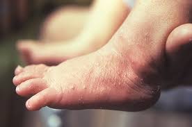 Often it is just a matter of poor ventilation, tight shoes, itchy socks and accumulated sweat on the skin during the course of the day that lead to mild. Rashes In Children Learning Article Pharmaceutical Journal