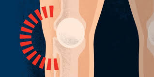 Lateral Outer Knee Pain Health Information Bupa Uk