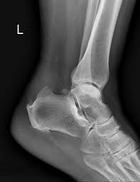 It is often accompanied by achilles tendinitis. Haglund Syndrome Radiology Case Radiopaedia Org