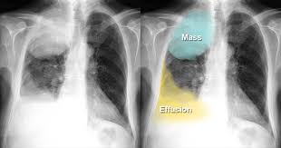 Image result for lung cancer xray