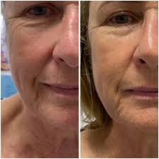 Hi everyone! I'm opening up a few model spots for DiamondGlow facials this  Saturday 8/2 at SIMMETRIA Medspa, and I'd love for you to be part of it 💛  This is a