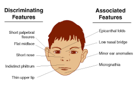An epicanthal fold is a skin fold of the upper eyelid covering the inner corner of the eye. What Are The Facial Characteristics Of Fetal Alcohol Syndrome Pediatriceducation Org