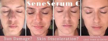 Hey can I use vitamin c cream and sunscreen for sunburn?