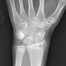 Image result for Wrist XRay