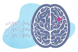 Image result for Status Epilepticus