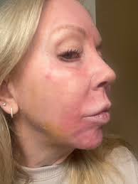 Sciton Erbium Laser with Platelet-Derived Growth Factor topical  post-treatment.