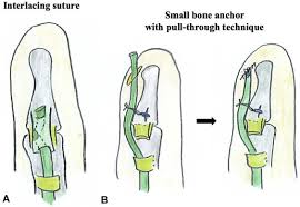The standard test 1 is performed for testing the fds tendons of middle, ring and little fingers. Flexor Tendon Grafting Using Extrasynovial Tendons Followed By Early Active Mobilization Journal Of Hand Surgery Global Online