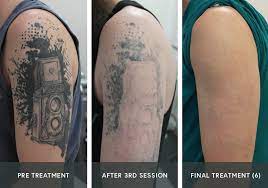 Picosure Tattoo Removal Uk Andrea Catton Laser Clinic Burnley Picosure Tattoo Removal Tattoos Tattoo Removal