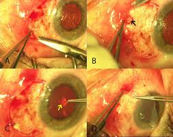 Start at the top and support theskin as you go. Foreign Body Episcleral Suture Granulomas Mimicking Nodular Anterior Scleritis Bmj Case Reports