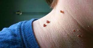 Maybe you would like to learn more about one of these? Kenali 10 Jenis Tumor Jinak Berdasarkan Letaknya Serta Cara Deteksinya