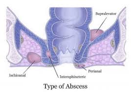Image result for Perirectal Abscess