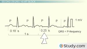 Image result for Atrioventricular Block