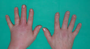 Image result for Dactylitis