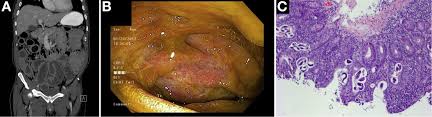 Image result for Adynamic Ileus