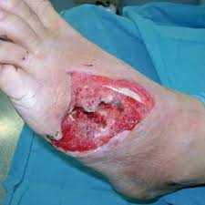 You don't need realistic weapon i'm happy present to you my first mod gunshot wound or simply gsw! Pdf Gunshot Injury Of The Foot Treatment And Procedures A Role Of Negative Pressure Wound Therapy