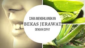 Langsung saja lihat caranya di bawah Cara Menghilangkan Bekas Jerawat Dengan Cepat Menggunakan Lidah Buaya Youtube