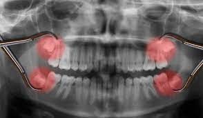 ألم ضرس العقل Wisdom Teeth Removal Wisdom Teeth Tooth Extraction