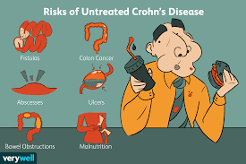 Risks Of Untreated Crohn S Disease