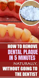 Dental Plaque Is The Buildup Of Food Waste At Both The Inner And External Teeth Surfaces This Is If The Residues Harden And Dental Plaque Gum Care Gum Health