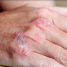 A psoríase é uma doença crônica e cíclica da pele. Pacientes Com Psoriase Passarao A Contar Com Medicamentos Biologicos No Tratamento Ofertado Pelo Sus