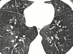 The cdc study sheds some light on the teen vaping uptick. Popcorn Lung Causes Symptoms And Treatment